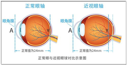 视网膜脱离 不能承受的高度近视眼并发症
